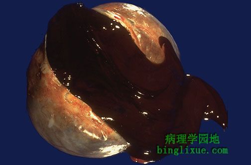 女性疾病之巧克力囊肿_健康知识